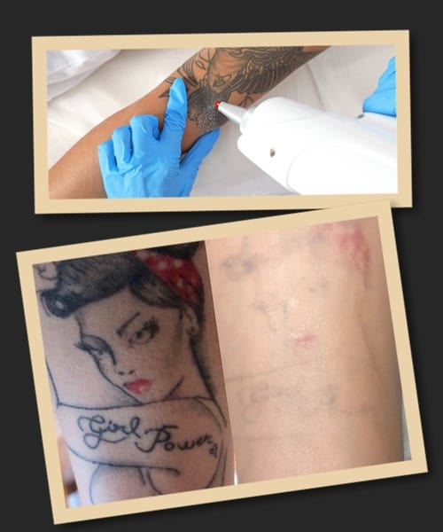 Лазерний метод видалення тату