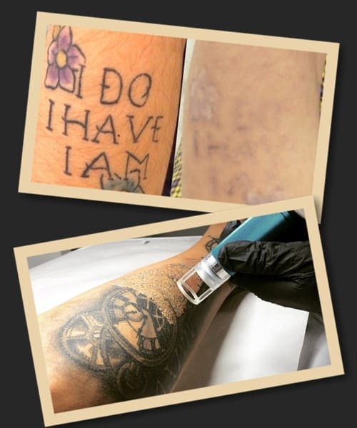 переваги лазерного методу видалення тату