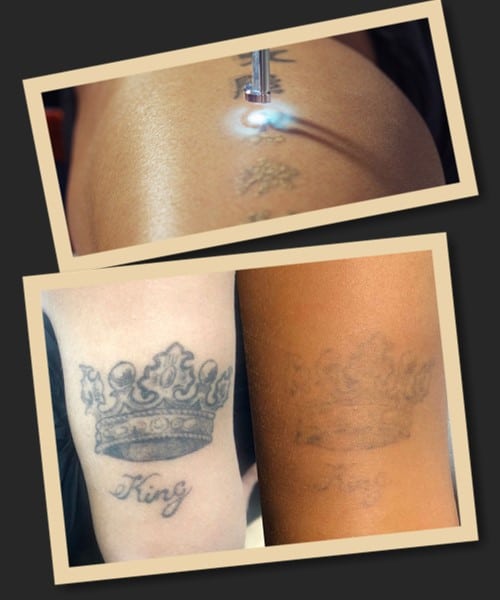 Як швидко можна звести татуювання