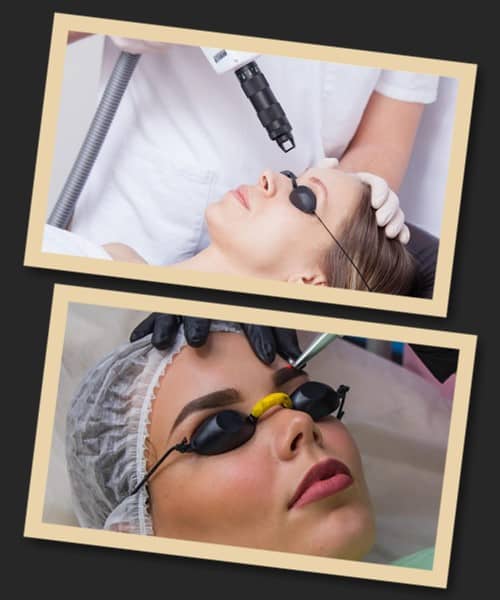 Вивести брови лазером