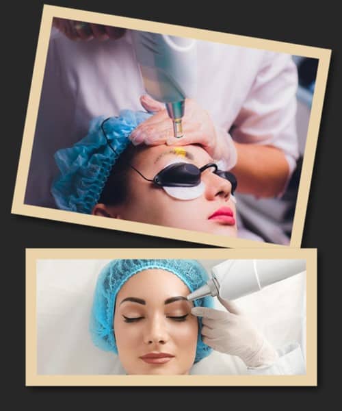 особливості лазерного методу виведення татуажу