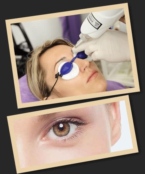 атравматичний метод виведення татуажу