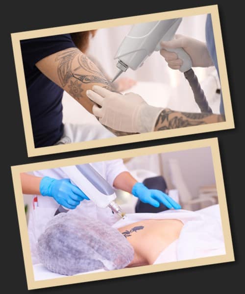 Як прибрати татуювання без наслідків