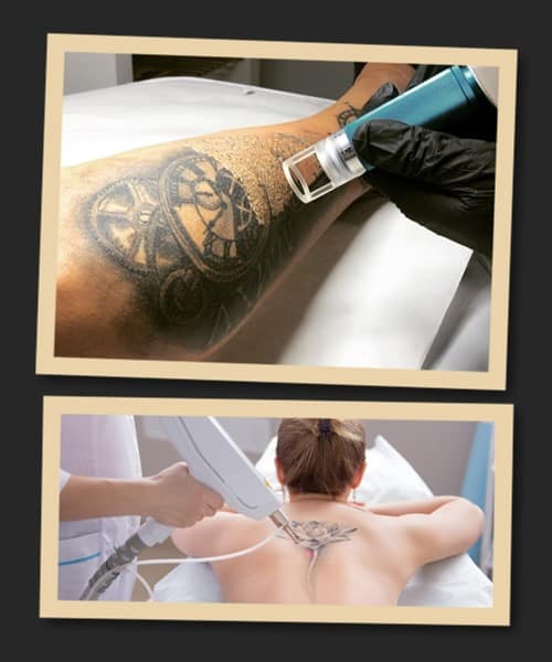 Методи зведення тату