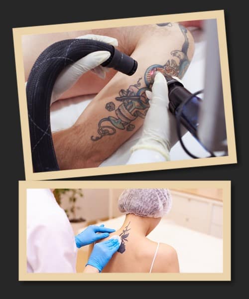 Способи видалення татуювань