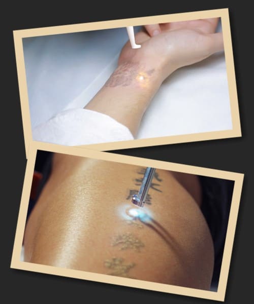 Видалення татуювання