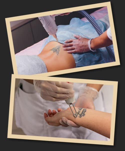 після виведення тату