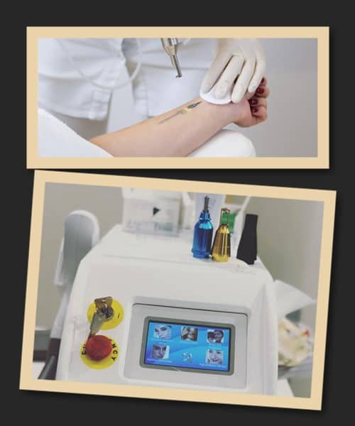 лазер для освітлення тату