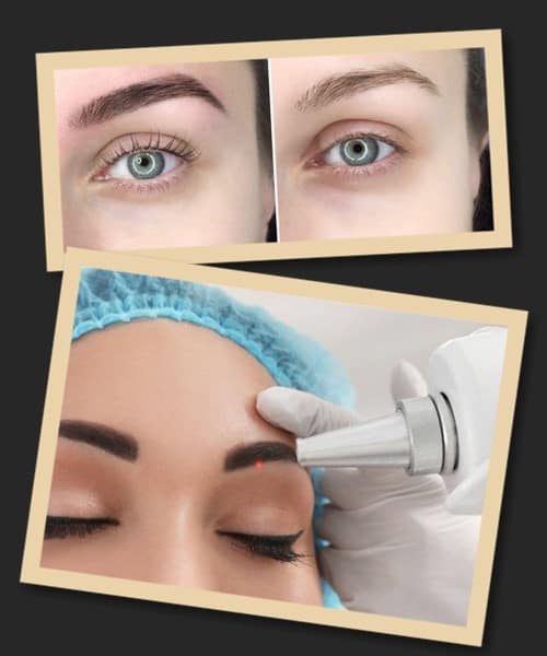 Брови після видалення татуажу лазером