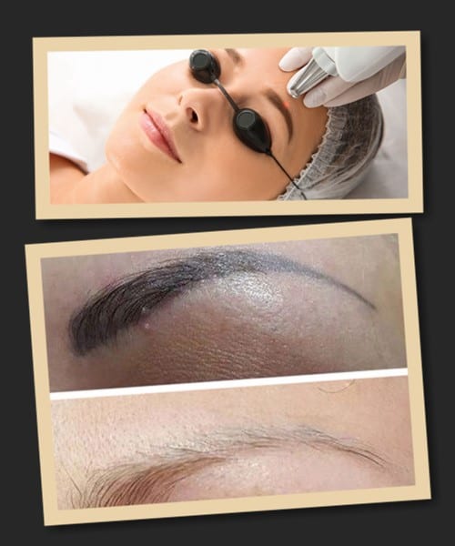 Лазерний метод видалення татуажу