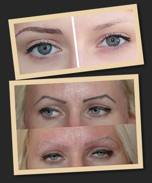 видалення татуажу лазером