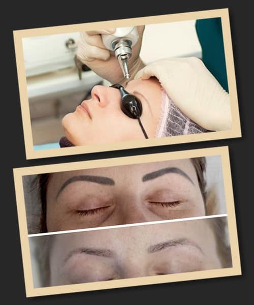 Перед лазерним виведенням татуажу брів