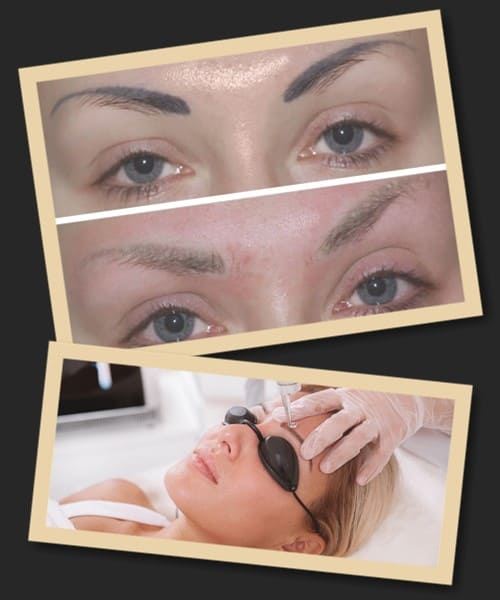 після сеансу лазерного видалення татуажу