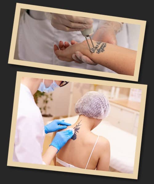 Чому іноді доводиться видаляти свіже татуювання