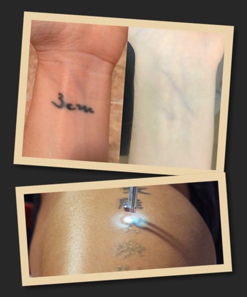 видалити тату