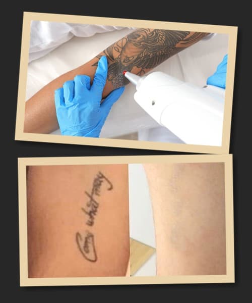 видалити тату без шрамів