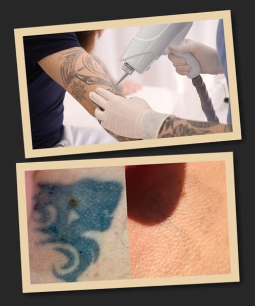 методи видалення тату