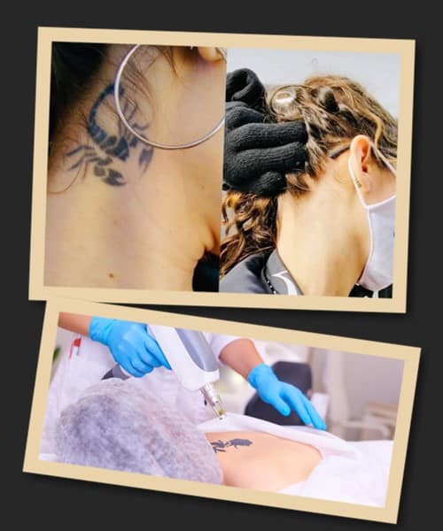 Найбезпечніший метод виведення тату – лазерний