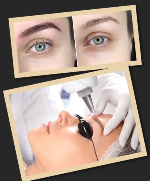 сверблять брови після лазерного видалення татуажу