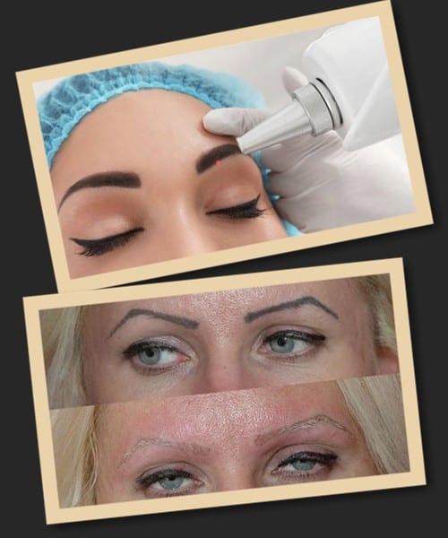 Переваги лазерного методу видалення тату