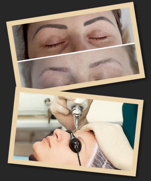 лазерний метод зведення татуажу