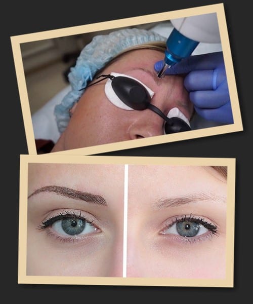 видалити татуаж брів лазером