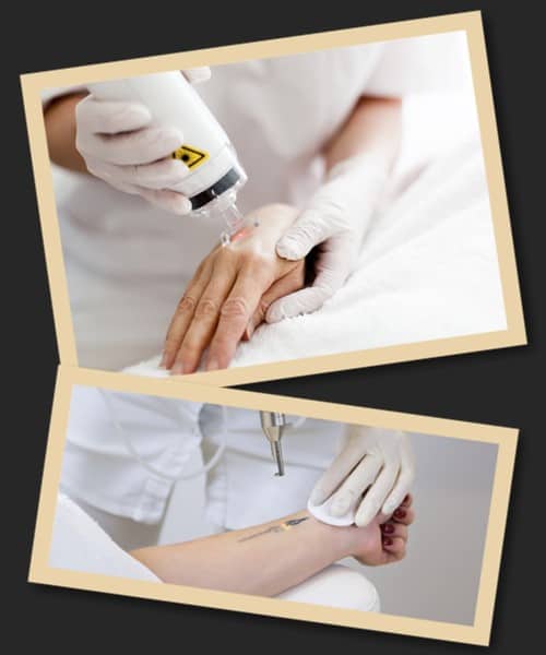 Процес лазерного видалення тату