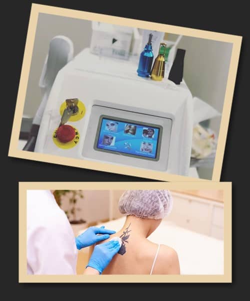 звести татуювання лазером