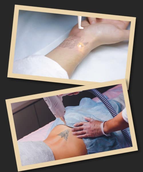 де видалити татуювання