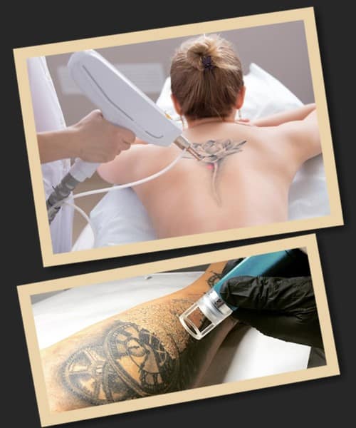 Який метод вибрати для видалення тату