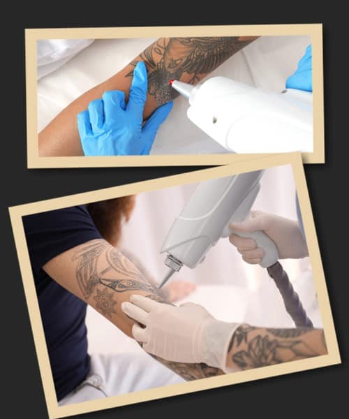 Де видалити татуювання у Києві