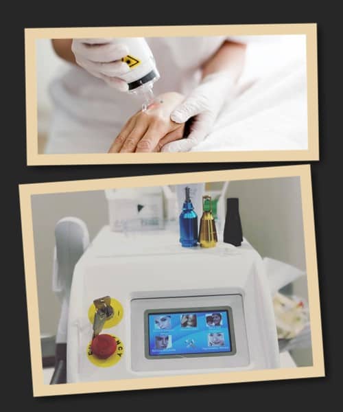 Як прискорити видалення татуювання