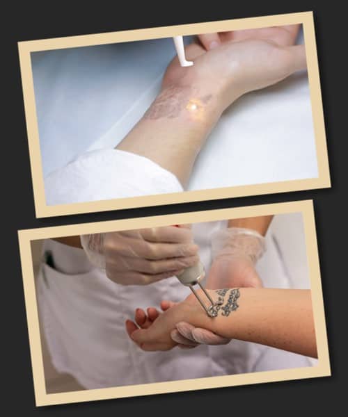 Тривалість курсу лазерного зведення татуювання