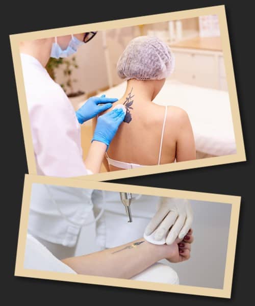 Як прискорити видалення тату