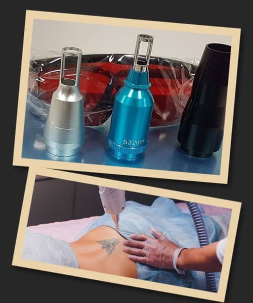 видалення тату лазером