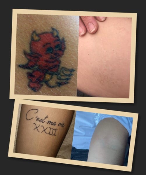 Лазерний метод зведення тату