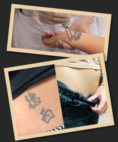 Способи видалення татуювань