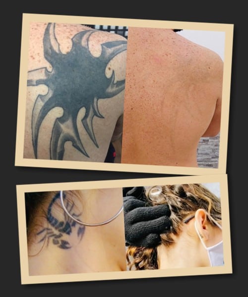 лазерне видалення татуювань