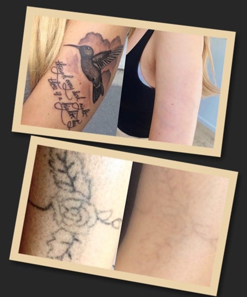 шкіра після видалення тату
