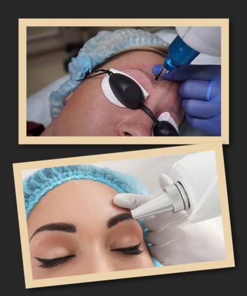 вивести старий татуаж брів в Києві