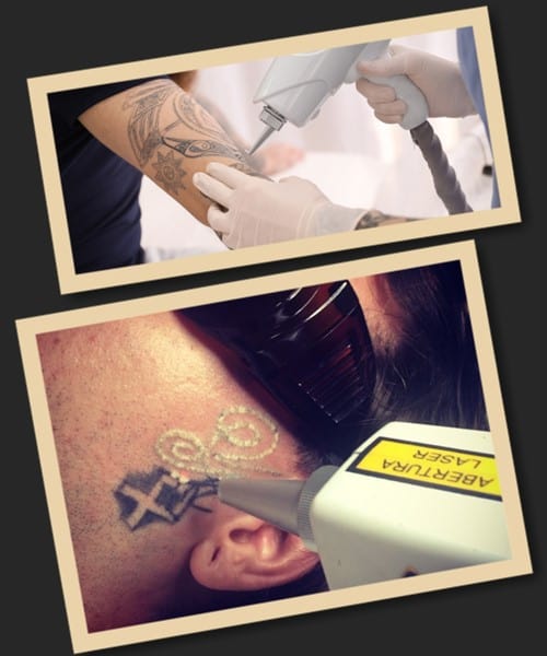 Лазерний метод видалення татуювань