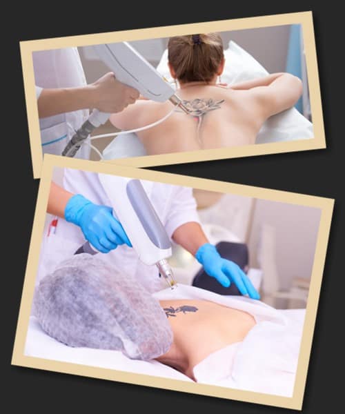 Як виводять татуювання: процес