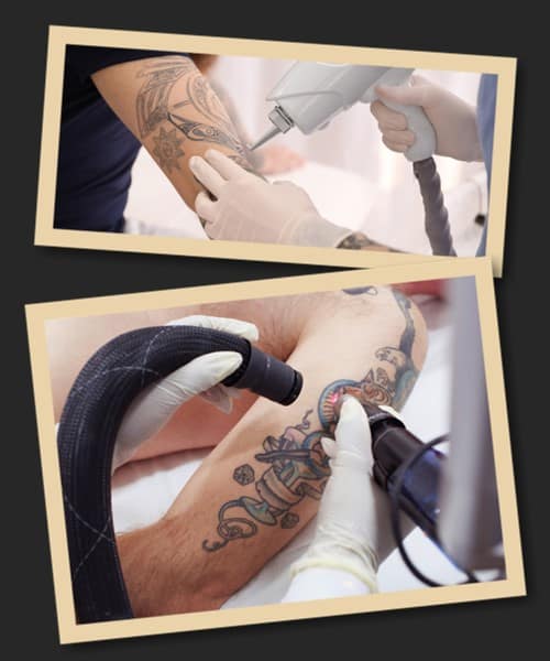 Технологія видалення татуювань лазером