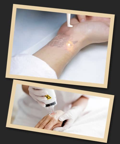 ефективність та швидкість зведення тату лазером