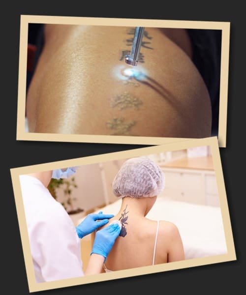 Лазерний метод для зведення тату