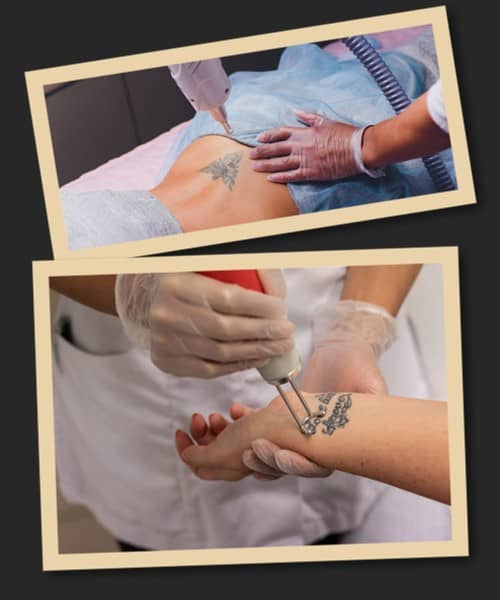 Переваги лазерного методу видалення тату