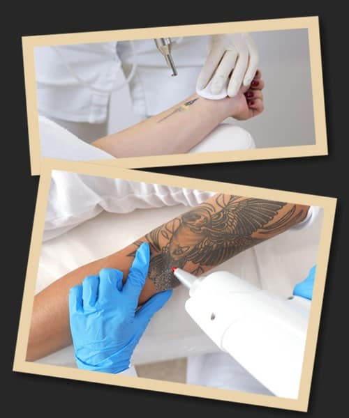 як виводять тату (процес)