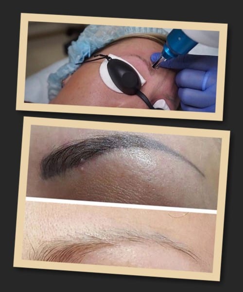 Лазер як найкращий метод видалення перманентного макіяжу