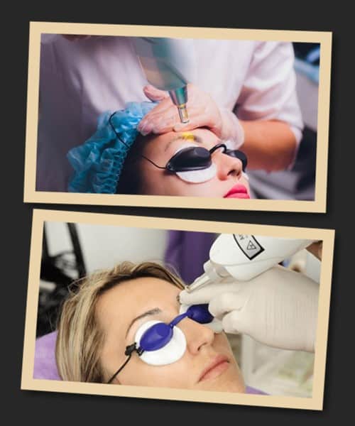 видалення татуажу брів