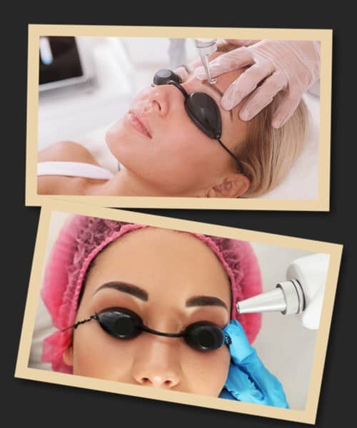 видалення татуажу ремувером